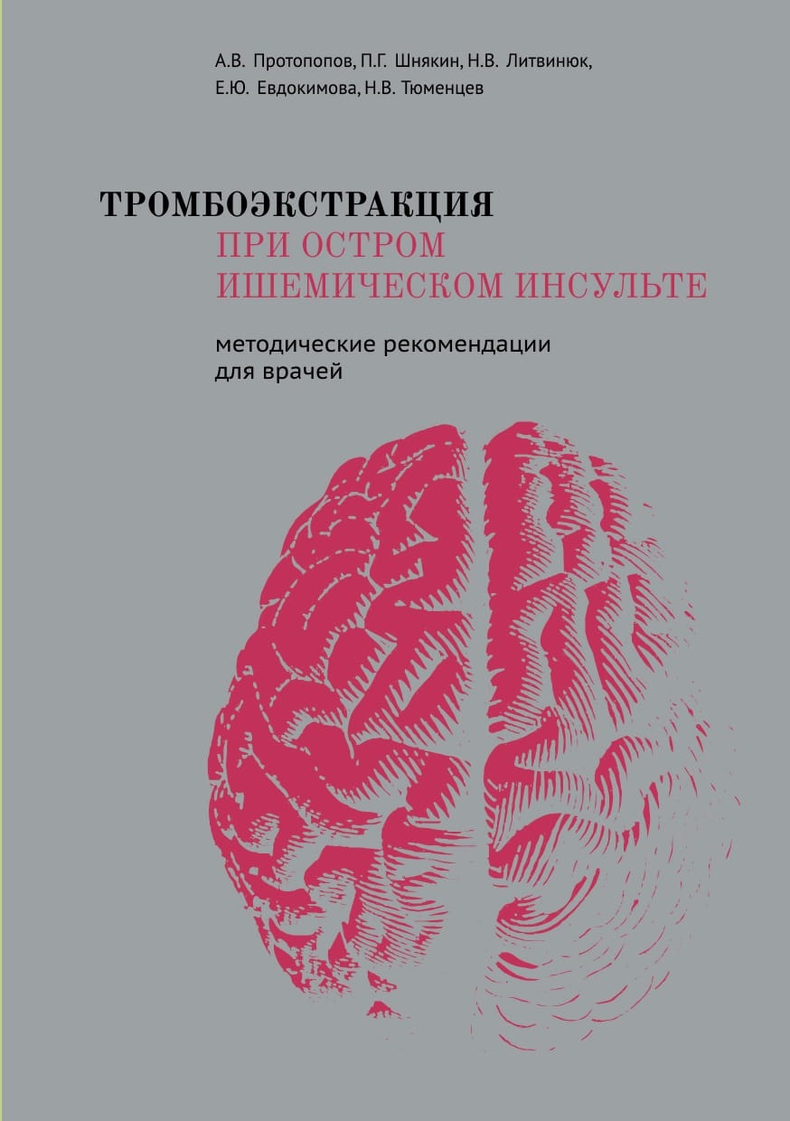 Тромбоэкстракция при остром ишемическом инсульте (методические рекомендации для врачей)